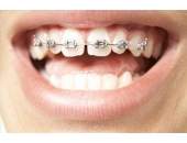 Tại sao bác sĩ lại đề nghị nhổ răng khi răng vẫn còn tốt ?