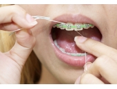 Chăm sóc hàm răng sau khi niềng răng
